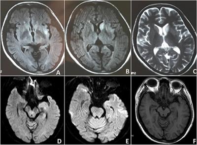 Anti-N-methyl-D-Aspartate Receptor Encephalitis Mimicking Sporadic Creutzfeldt–Jakob Disease